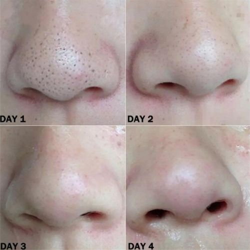 Nose Blackhead Remover Strips | Deep Cleansing Pore Strips for Clear Skin - Pack of 25